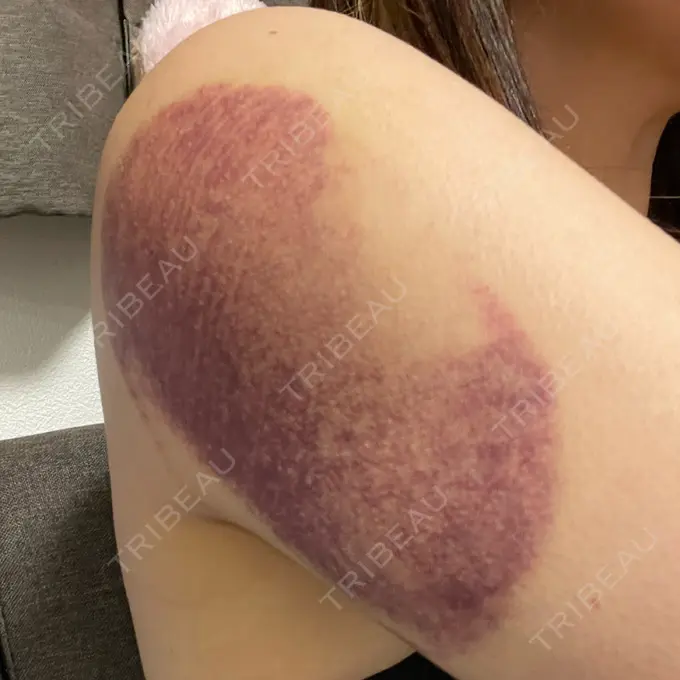 脂肪冷却（お腹） / 脂肪冷却（二の腕） DMTC CLINIC 日本橋院 DAY 2 メイン用