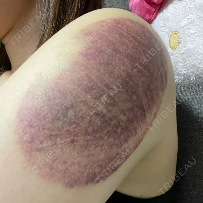 脂肪冷却（お腹） / 脂肪冷却（二の腕） DMTC CLINIC 日本橋院 DAY 2 メイン用