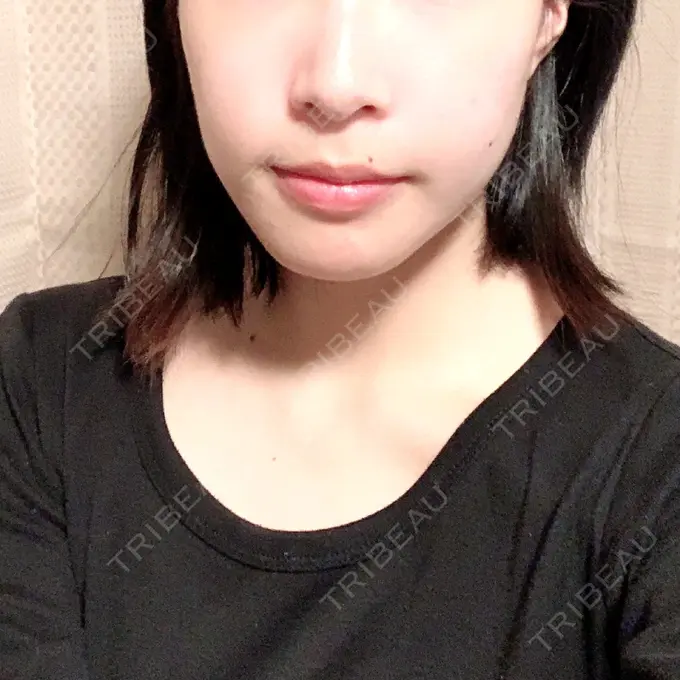 セットバック 大塚美容形成外科・歯科 大塚本院 DAY 80 メイン用