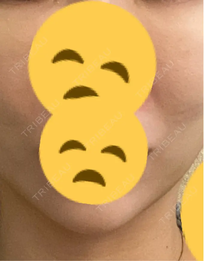 糸リフト / 脂肪吸引（顔） / 下まぶたの脂肪取り / 脂肪注入（目の下） 東京ココセランクリニック DAY 12 メイン用