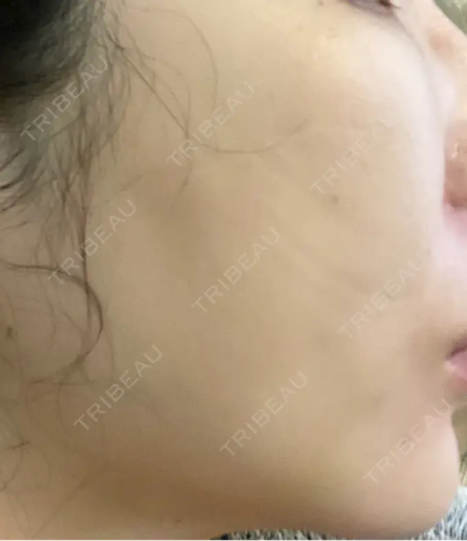 糸リフト / 脂肪吸引（顔） / 下まぶたの脂肪取り / 脂肪注入（目の下） 東京ココセランクリニック DAY 12 メイン用