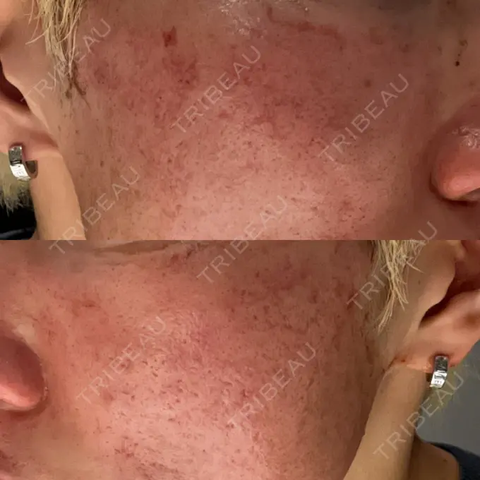 その他（肌） / ダーマペン / ニキビ治療 ゆきスキンクリニック 東池袋 DAY 0 メイン用