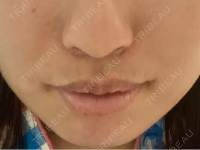 人中短縮 / 口唇縮小術 / 口角挙上 新宿ラクル美容外科クリニック 新宿院 DAY 75 メイン用