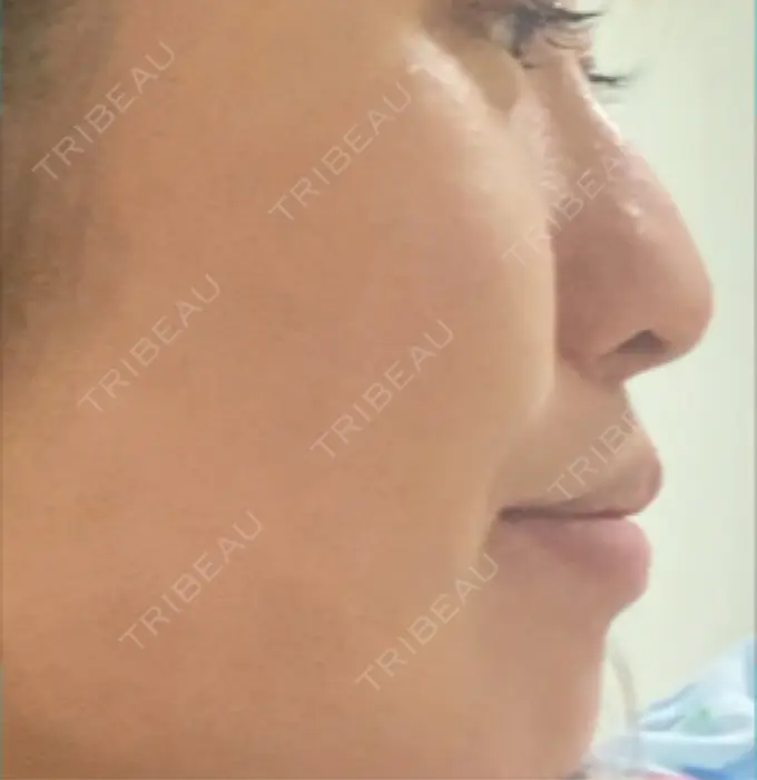 人中短縮 / 口唇縮小術 / 口角挙上 新宿ラクル美容外科クリニック 新宿院 DAY 75 メイン用