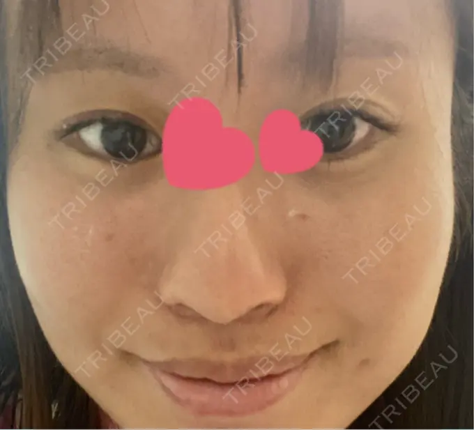 眼瞼下垂（非切開） / ピアス穴あけ / ニキビ治療 しむら皮膚科クリニック DAY 5 メイン用