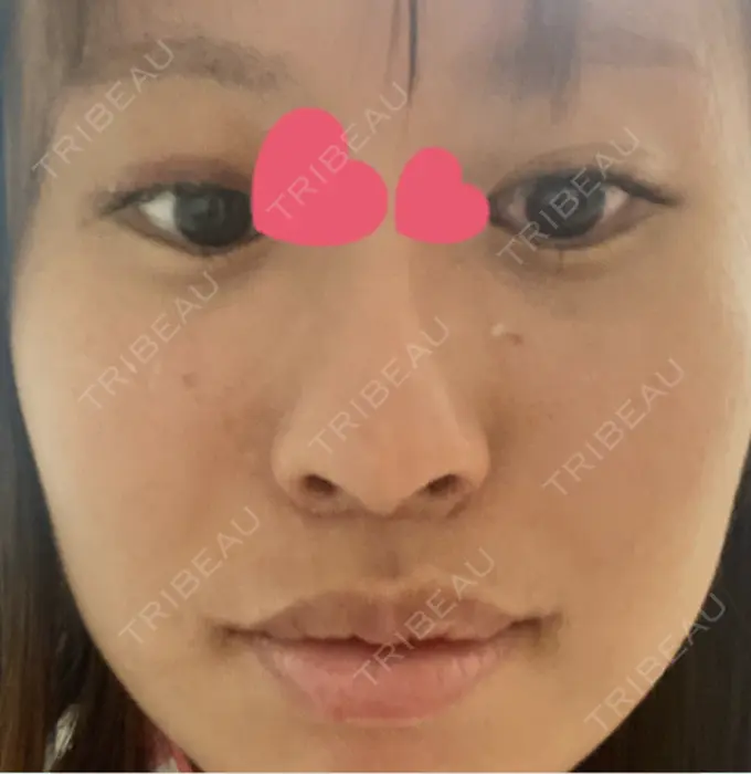 眼瞼下垂（非切開） / ピアス穴あけ / ニキビ治療 しむら皮膚科クリニック DAY 5 メイン用