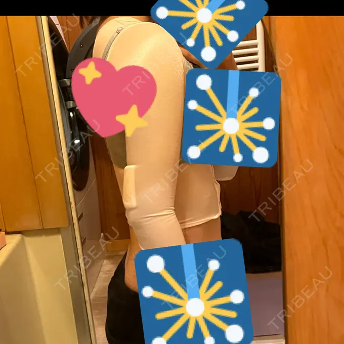 脂肪吸引（二の腕） / 脂肪吸引（肩） 湘南美容クリニック 大阪梅田本院 DAY 1 メイン用