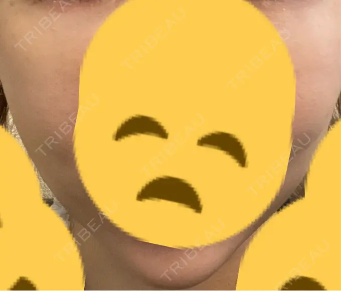 糸リフト / 脂肪吸引（顔） / 下まぶたの脂肪取り / 脂肪注入（目の下） 東京ココセランクリニック DAY 13 メイン用