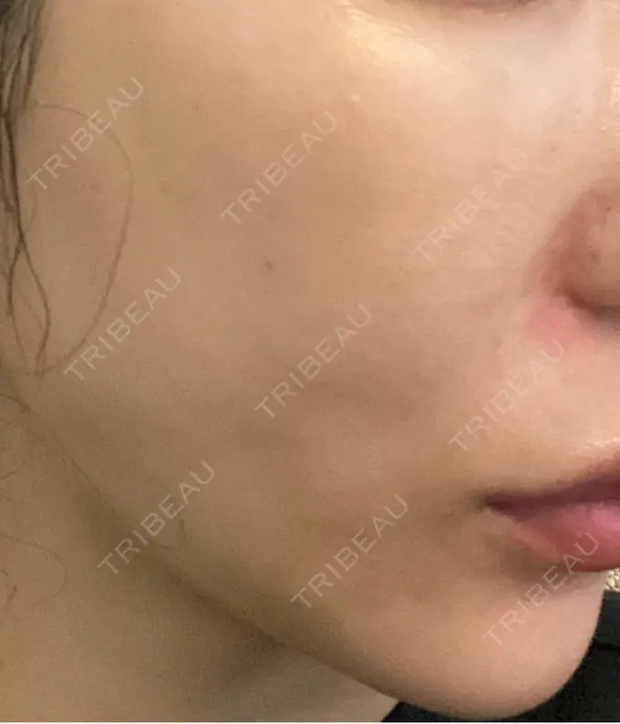 糸リフト / 脂肪吸引（顔） / 下まぶたの脂肪取り / 脂肪注入（目の下） 東京ココセランクリニック DAY 13 メイン用