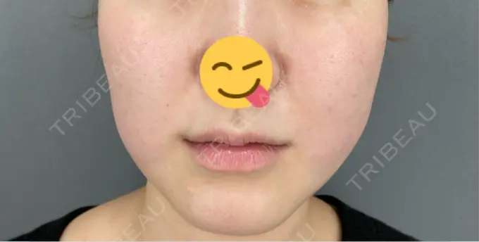 糸リフト / 脂肪吸引（顔） / 脂肪吸引注射（顔） ziz CLINIC DAY 0 メイン用