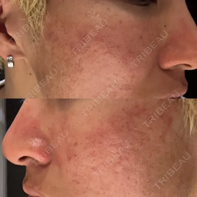 その他（肌） / ダーマペン / ニキビ治療 ゆきスキンクリニック 東池袋 DAY 1 メイン用