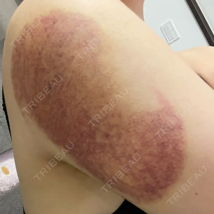 脂肪冷却（お腹） / 脂肪冷却（二の腕） DMTC CLINIC 日本橋院 DAY 4 メイン用