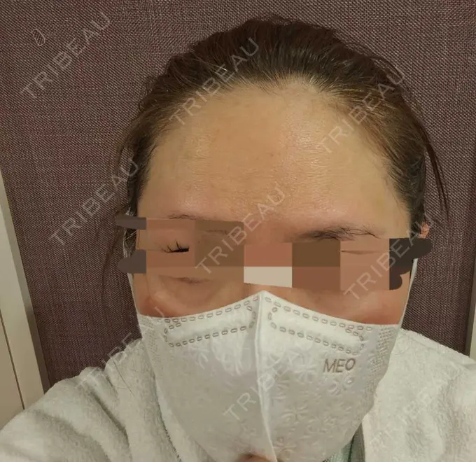 ボトックス（あご） / ボトックス（エラ・小顔） / ボトックス（額） もとび美容外科クリニック 新宿院 AFTER メイン用