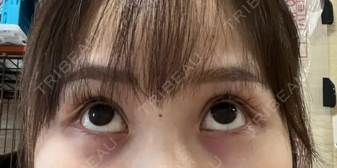 アートメイク（アイライン） Kinshicho Beauty Clinic （錦糸町ビューティークリニック） DAY 8 メイン用