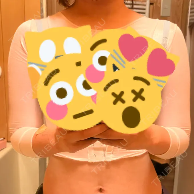 脂肪吸引（二の腕） / 脂肪吸引（肩） 湘南美容クリニック 大阪梅田本院 DAY 2 メイン用