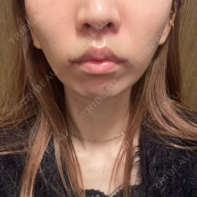人中短縮 / 口角挙上 新宿ラクル美容外科クリニック 新宿院 DAY 7 メイン用