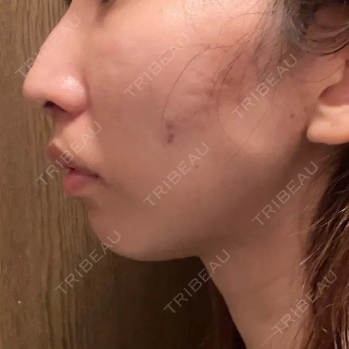 人中短縮 / 口角挙上 新宿ラクル美容外科クリニック 新宿院 DAY 7 メイン用