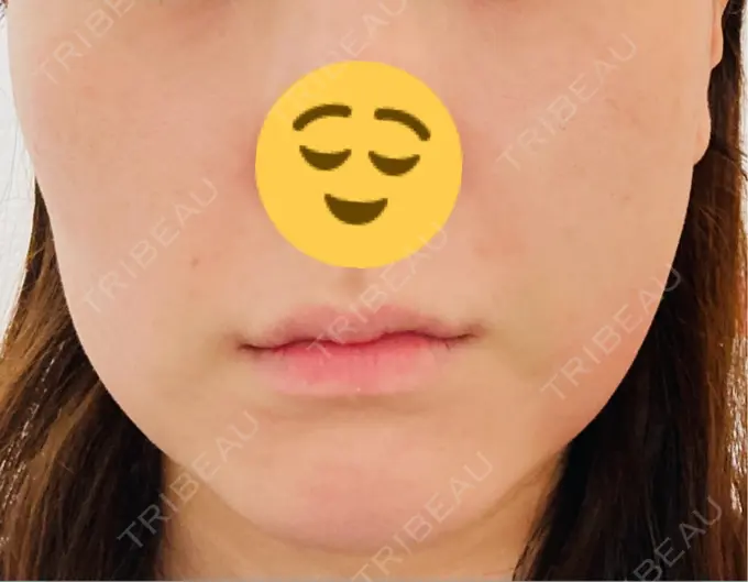 糸リフト / 脂肪吸引（顔） / 脂肪吸引注射（顔） ziz CLINIC DAY 1 メイン用