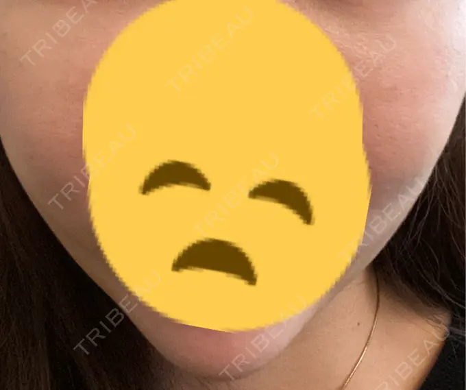 糸リフト / 脂肪吸引（顔） / 下まぶたの脂肪取り / 脂肪注入（目の下） 東京ココセランクリニック DAY 15 メイン用