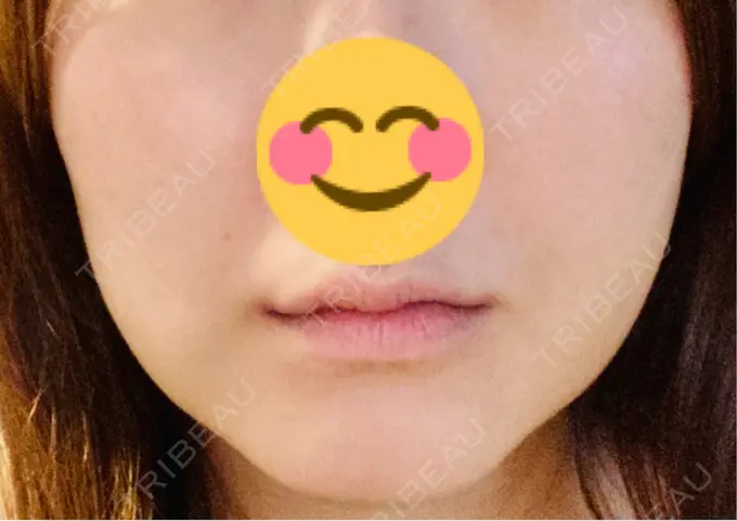 糸リフト / 脂肪吸引（顔） / 脂肪吸引注射（顔） ziz CLINIC DAY 2 メイン用