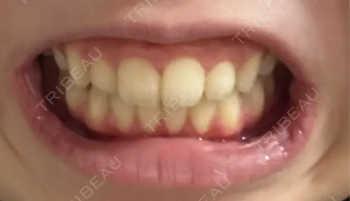 ホワイトニング LEAGRANT CLINIC 中目黒 DAY 19 メイン用