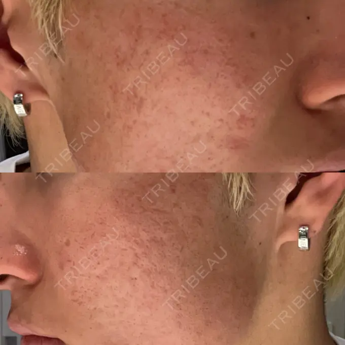 その他（肌） / ダーマペン / ニキビ治療 ゆきスキンクリニック 東池袋 DAY 3 メイン用