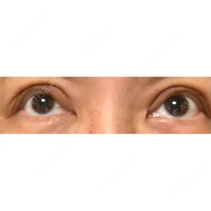 二重埋没 TCB東京中央美容外科 仙台広瀬通院 AFTER メイン用