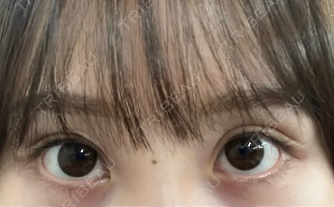 アートメイク（アイライン） Kinshicho Beauty Clinic （錦糸町ビューティークリニック） DAY 10 メイン用