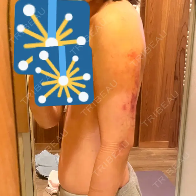 脂肪吸引（二の腕） / 脂肪吸引（肩） 湘南美容クリニック 大阪梅田本院 DAY 4 メイン用