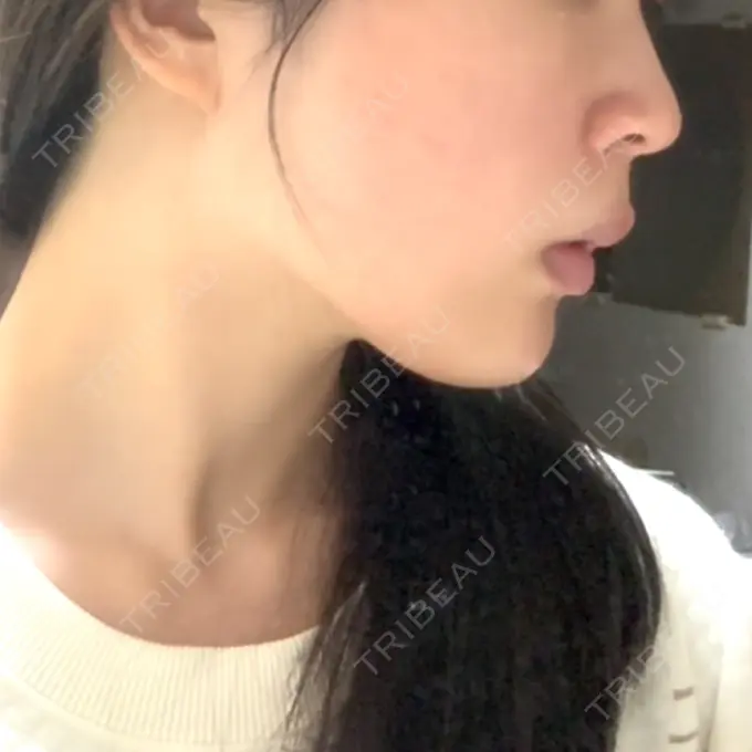 RF（高周波）たるみ治療 表参道メディカルクリニック 表参道院 DAY 3 メイン用