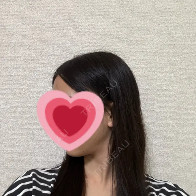 糸リフト / 脂肪吸引（顔） / ボトックス（エラ・小顔） RIVER CLINIC（リバークリニック） DAY 90 メイン用