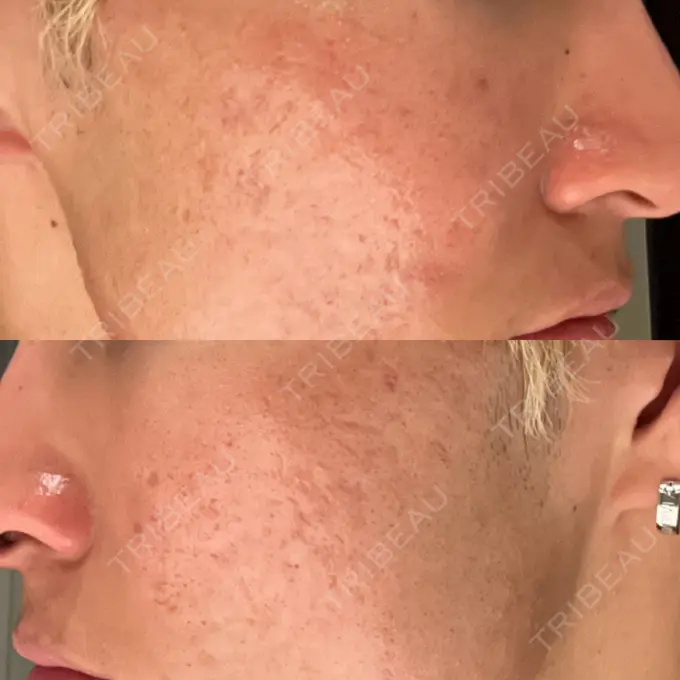 その他（肌） / ダーマペン / ニキビ治療 ゆきスキンクリニック 東池袋 DAY 4 メイン用