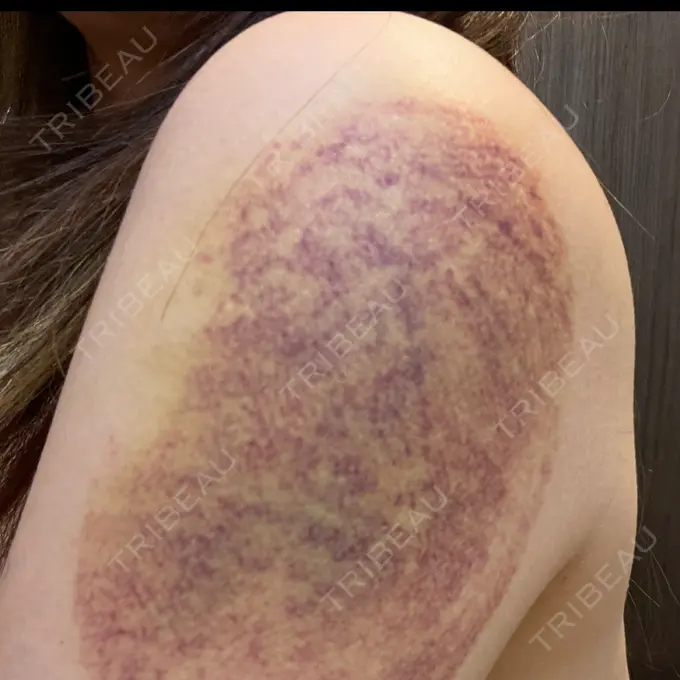 脂肪冷却（お腹） / 脂肪冷却（二の腕） DMTC CLINIC 日本橋院 AFTER メイン用