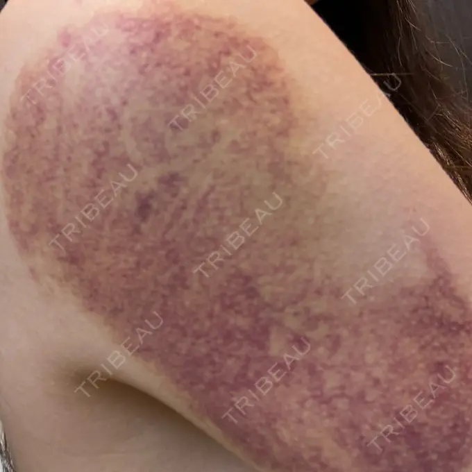 脂肪冷却（お腹） / 脂肪冷却（二の腕） DMTC CLINIC 日本橋院 DAY 5 メイン用