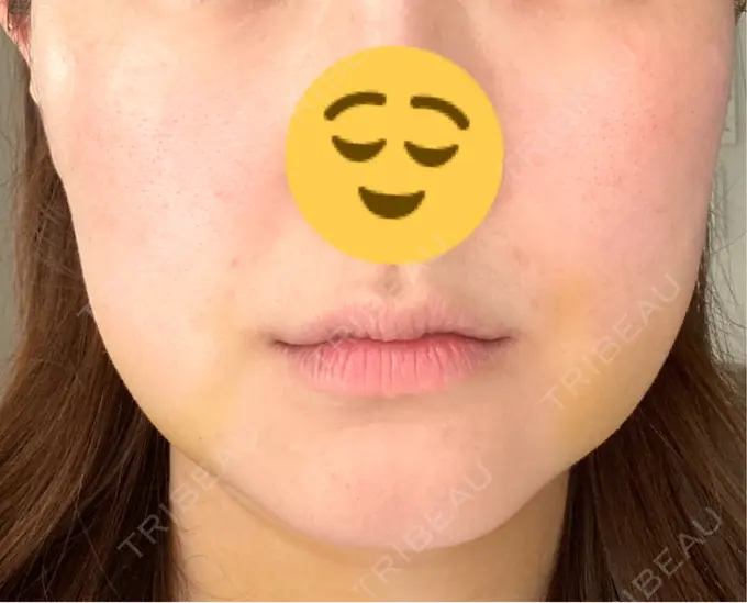 糸リフト / 脂肪吸引（顔） / 脂肪吸引注射（顔） ziz CLINIC DAY 4 メイン用