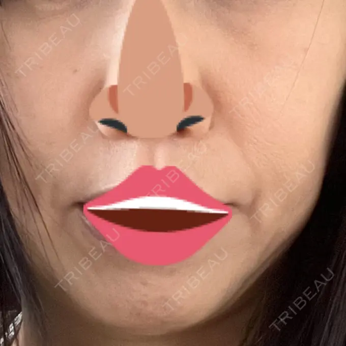 イオン導入 / 毛穴洗浄（ハイドラフェイシャルなど） GRACIA clinic 【グラシアクリニック】 AFTER メイン用