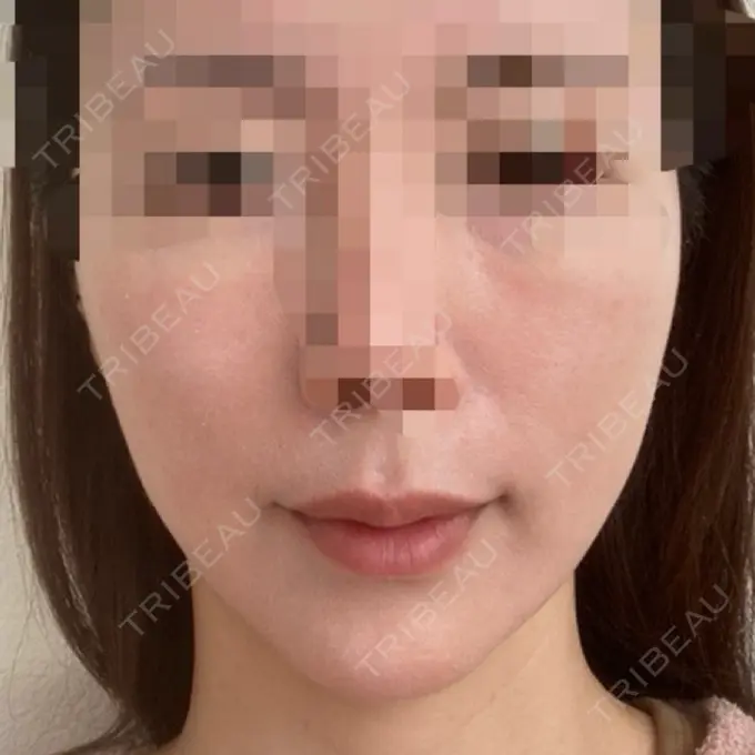 糸リフト / 骨切り（あご） / 脂肪吸引注射（顔） 銀座マイアミ美容外科 AFTER メイン用