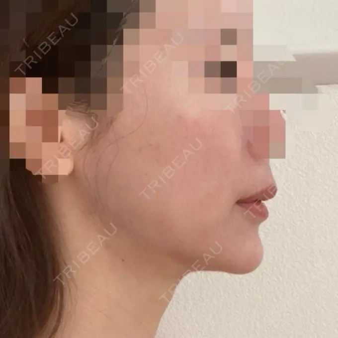 糸リフト / 骨切り（あご） / 脂肪吸引注射（顔） 銀座マイアミ美容外科 DAY 94 メイン用