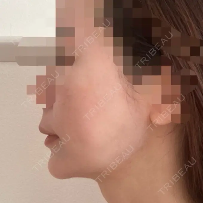 糸リフト / 骨切り（あご） / 脂肪吸引注射（顔） 銀座マイアミ美容外科 DAY 94 メイン用