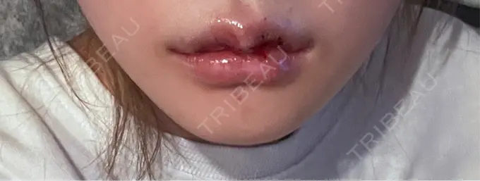 ヒアルロン酸注入（唇） / その他（口元） R Beauty CLINIC 銀座院 AFTER メイン用