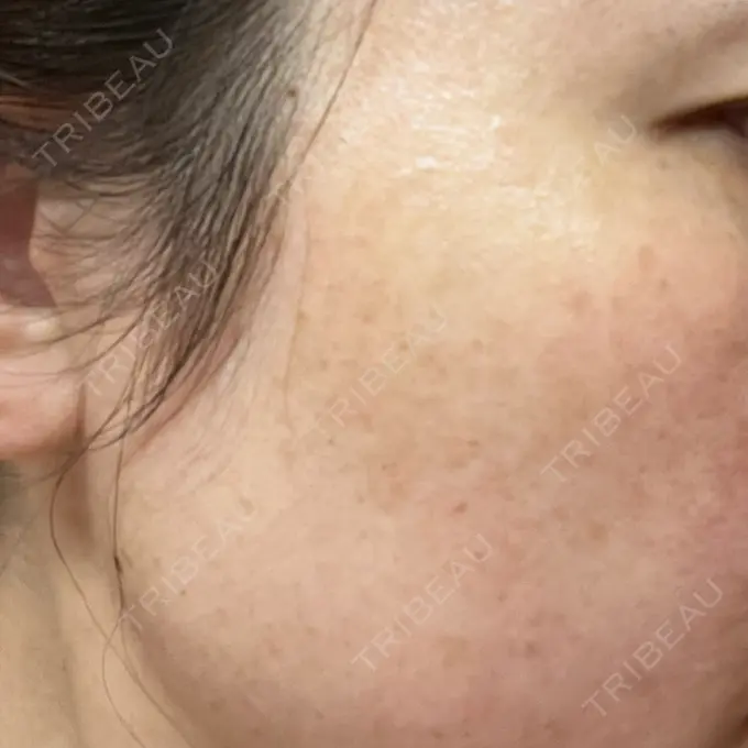 ルメッカ ルラ美容クリニック 広島院 DAY 4 メイン用