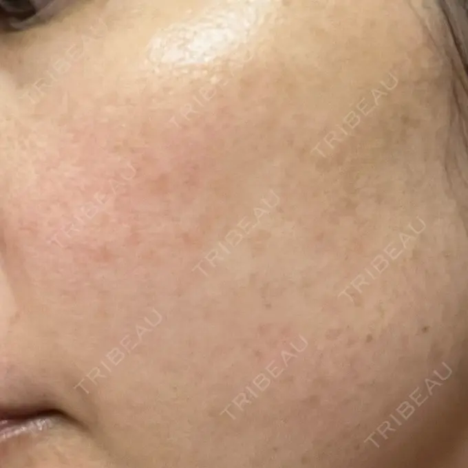 ルメッカ ルラ美容クリニック 広島院 DAY 6 メイン用