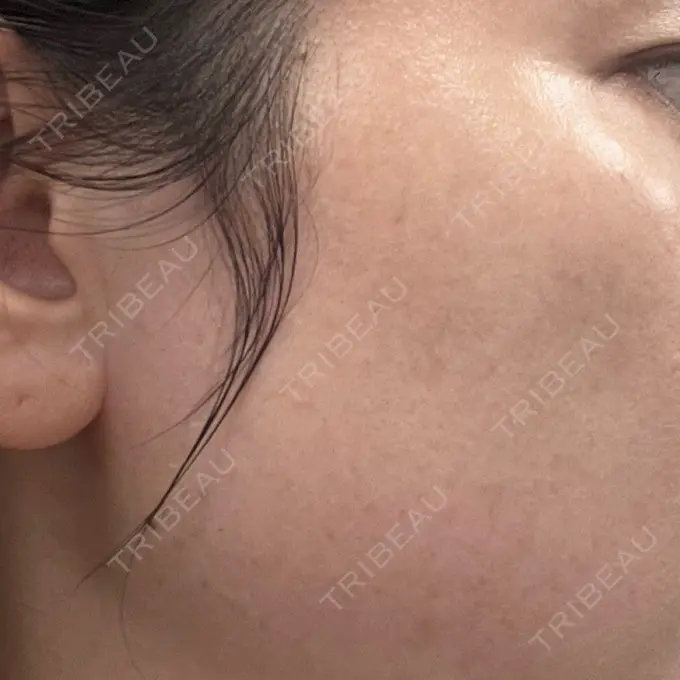 ルメッカ ルラ美容クリニック 広島院 DAY 7 メイン用