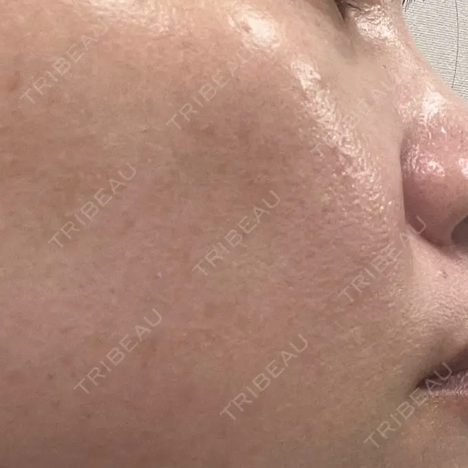 ルメッカ ルラ美容クリニック 広島院 DAY 9 メイン用