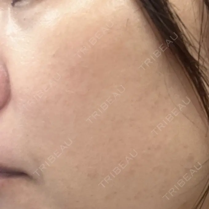 ルメッカ ルラ美容クリニック 広島院 AFTER メイン用