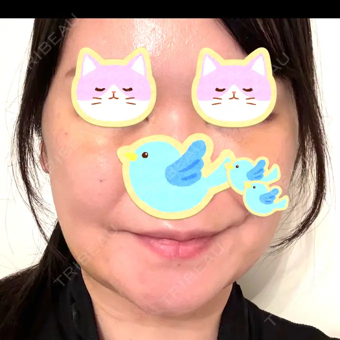 糸リフト / クマ治療 / 脂肪吸引（顔） / 脂肪注入（目の下） / ヒアルロン酸注入（涙袋） / ヒアルロン酸注入（唇） 東京シンデレラ美容外科 池袋院 DAY 4 メイン用