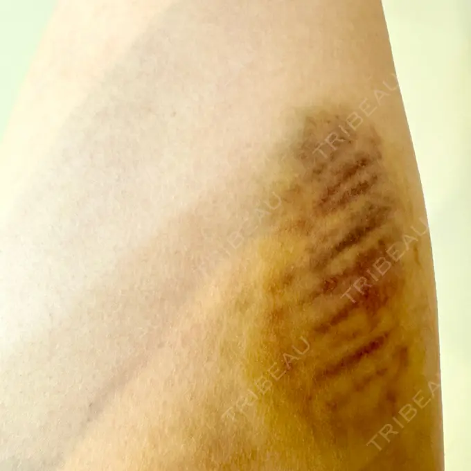 糸リフト / クマ治療 / 脂肪吸引（顔） / 脂肪注入（目の下） / ヒアルロン酸注入（涙袋） / ヒアルロン酸注入（唇） 東京シンデレラ美容外科 池袋院 DAY 4 メイン用