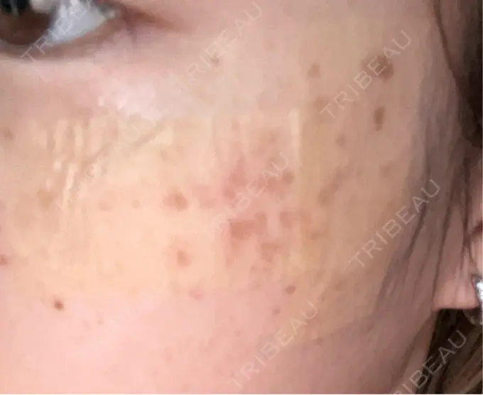 シミ取りレーザー S-Laboクリニック 渋谷院 DAY 2 メイン用