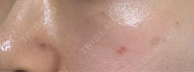 ピコスポット 日比谷セントラルクリニック DAY 12 メイン用