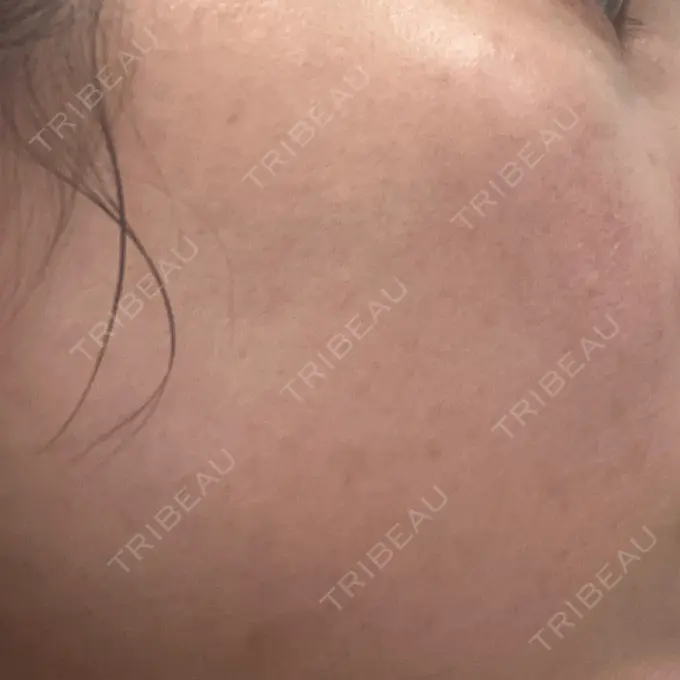 ルメッカ ルラ美容クリニック 広島院 DAY 10 メイン用